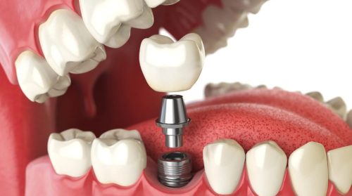 advantages of zygomatic implants
