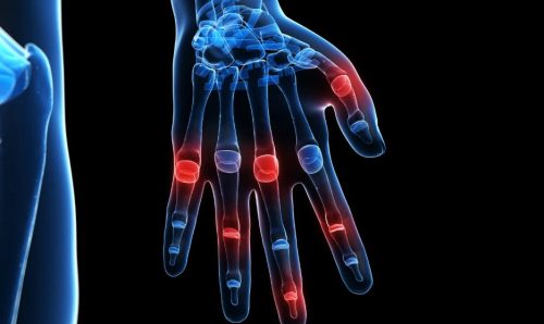 What is Inflammatory Arthritis