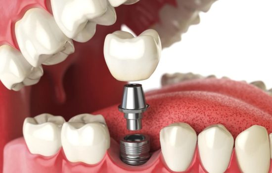advantages of zygomatic implants