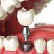 advantages of zygomatic implants